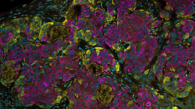 Treated human stem cells transplanted into a laboratory animal.
